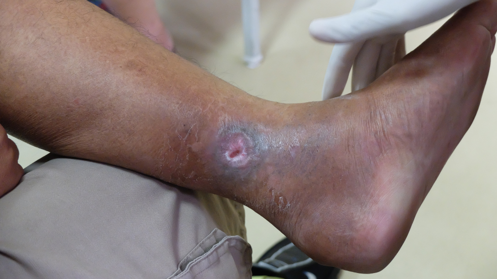 Jatyadi taila in chronic ulcer management